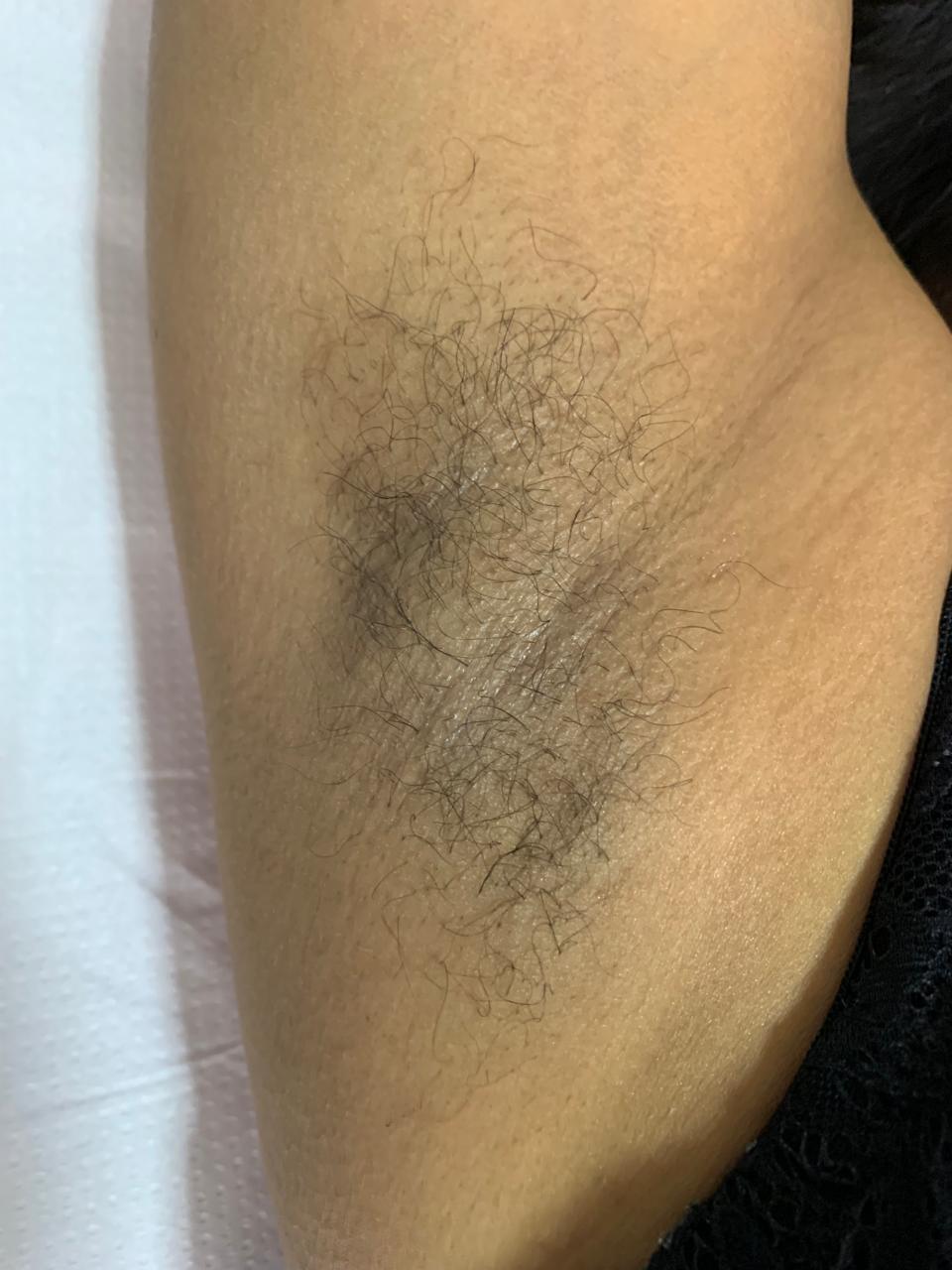 Axila feminina antes da depilação com cera natural em Taguatinga Norte