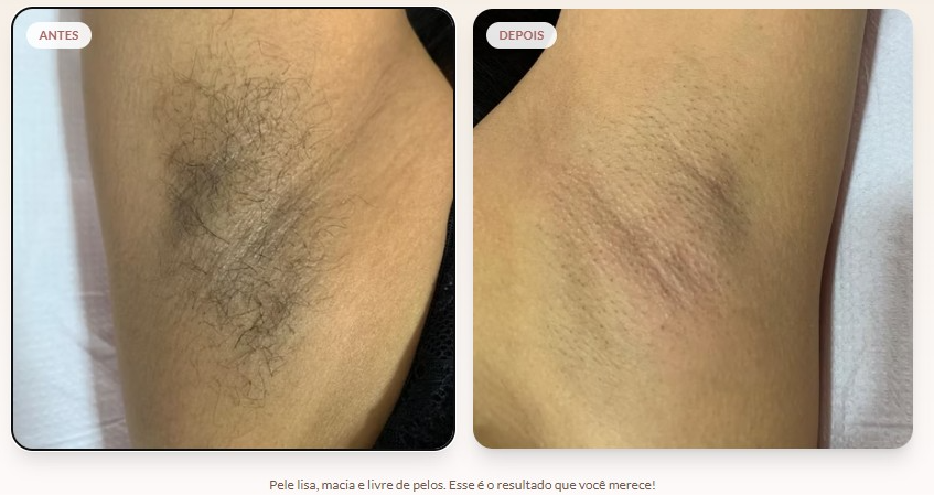 Antes e depois da depilação feminina com cera 100% natural em Taguatinga